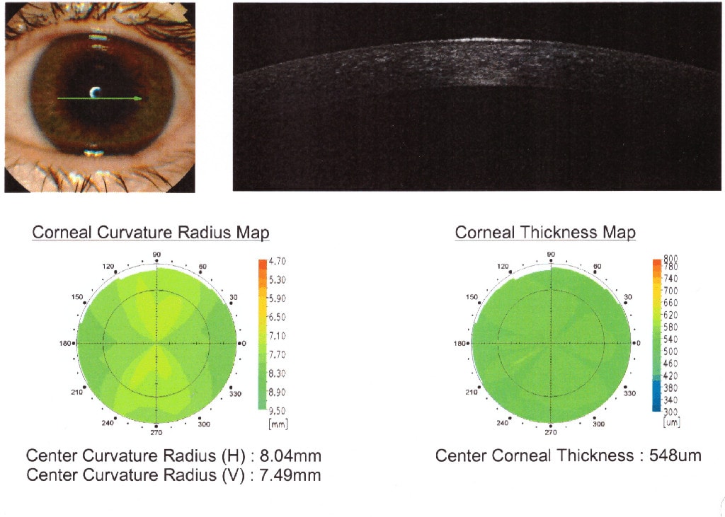 Pachymetrie -
            Messung der Dicke der Kornea (Augenhornhaut)
